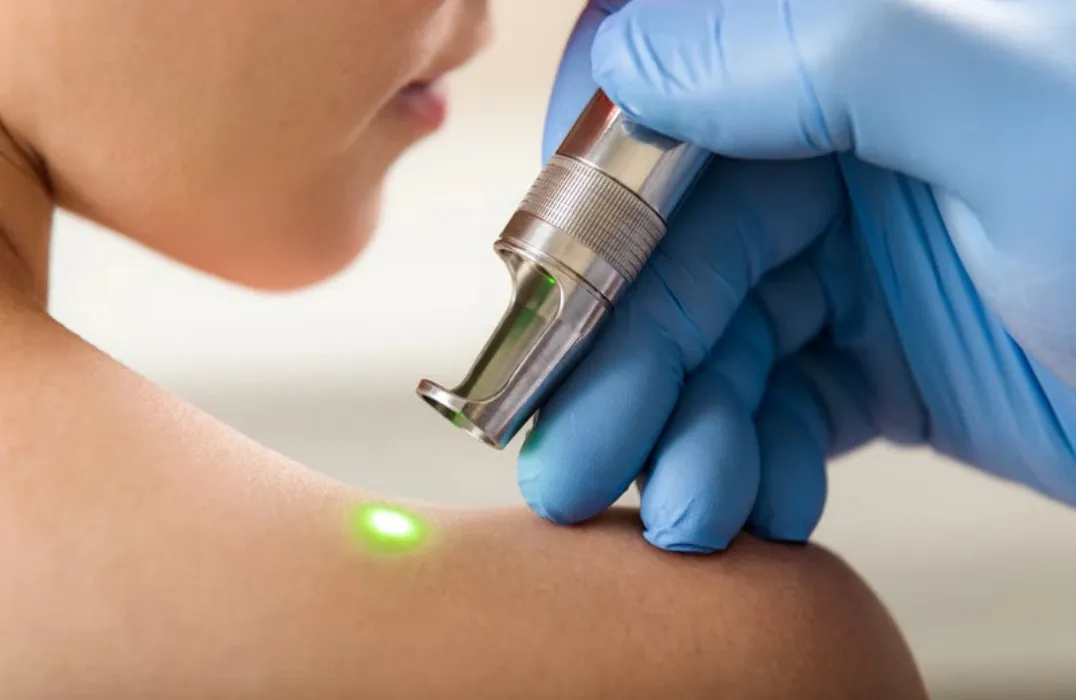 Anal Laser/ Bleaching Treatment