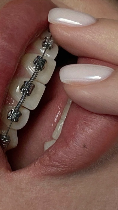 Teeth Treatment and Braces 