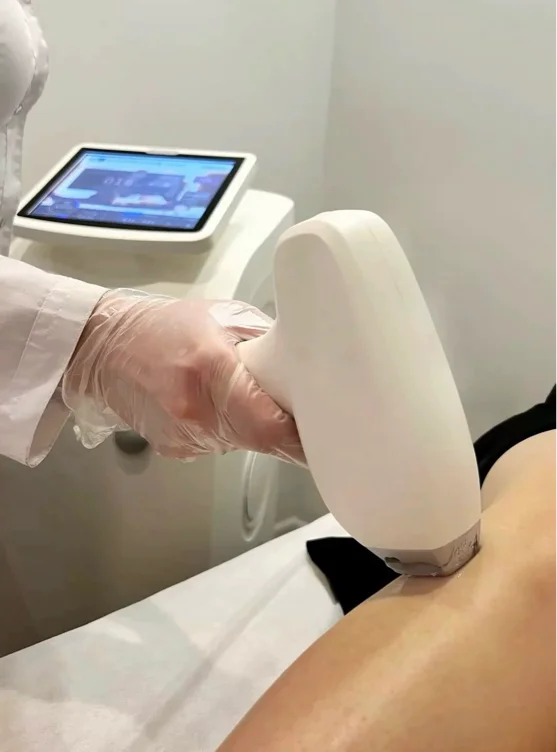 Laser hair removal on legs
