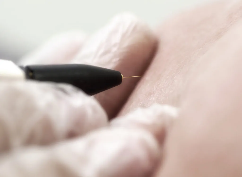 Electrolysis course for legs