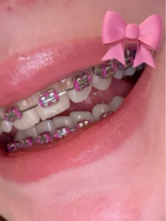 Braces Fund (Information in description) 