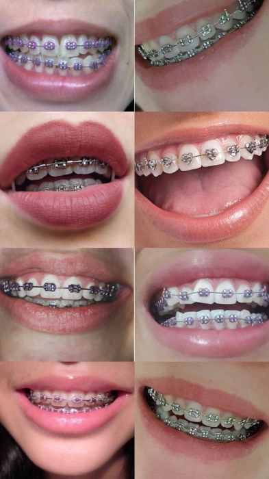 Braces Payments