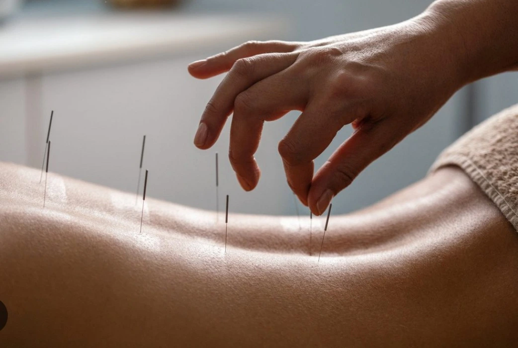 Acupuncture