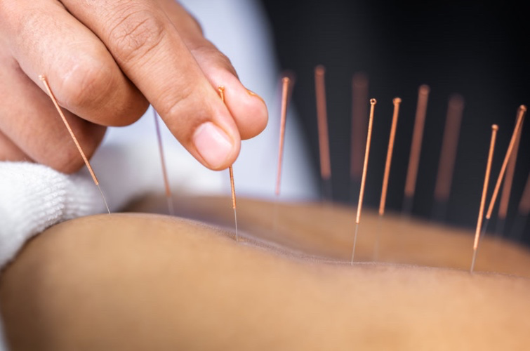 Acupuncture | 5 sessions 