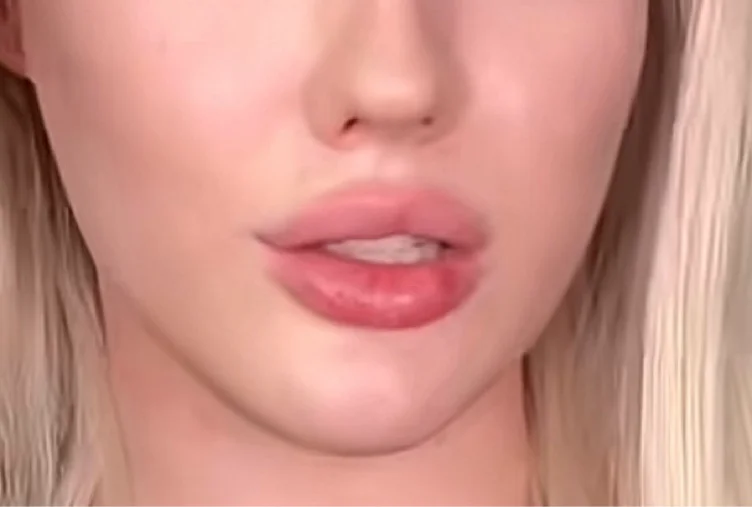 Lip filler 🫦