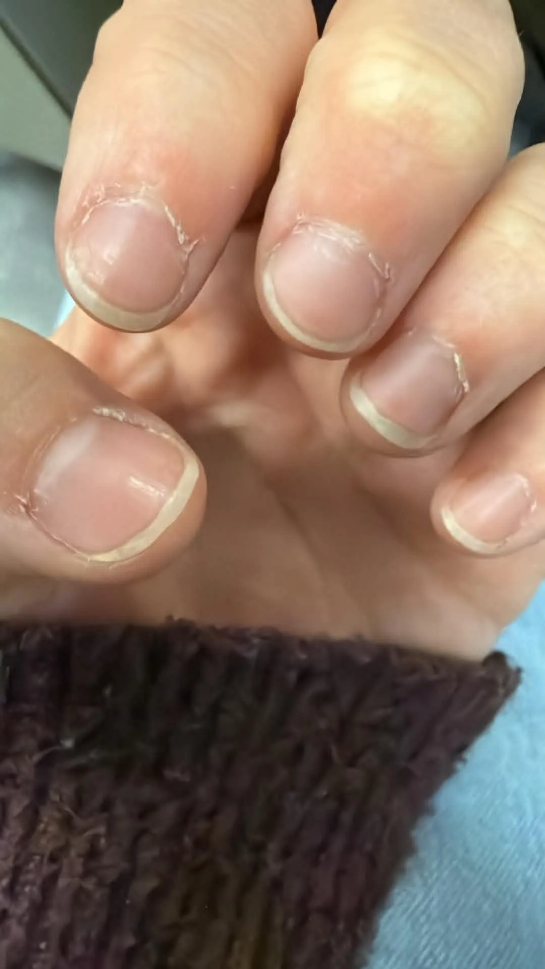 Emergency Nail Care!