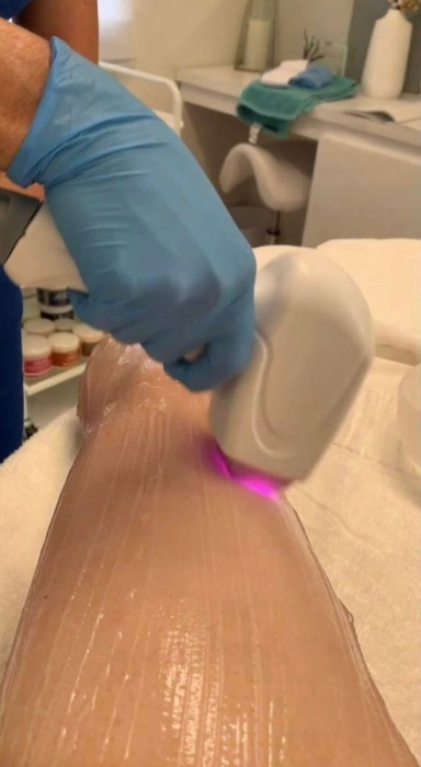 Laser hair removal sessions