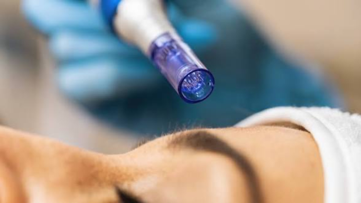 Microneedling