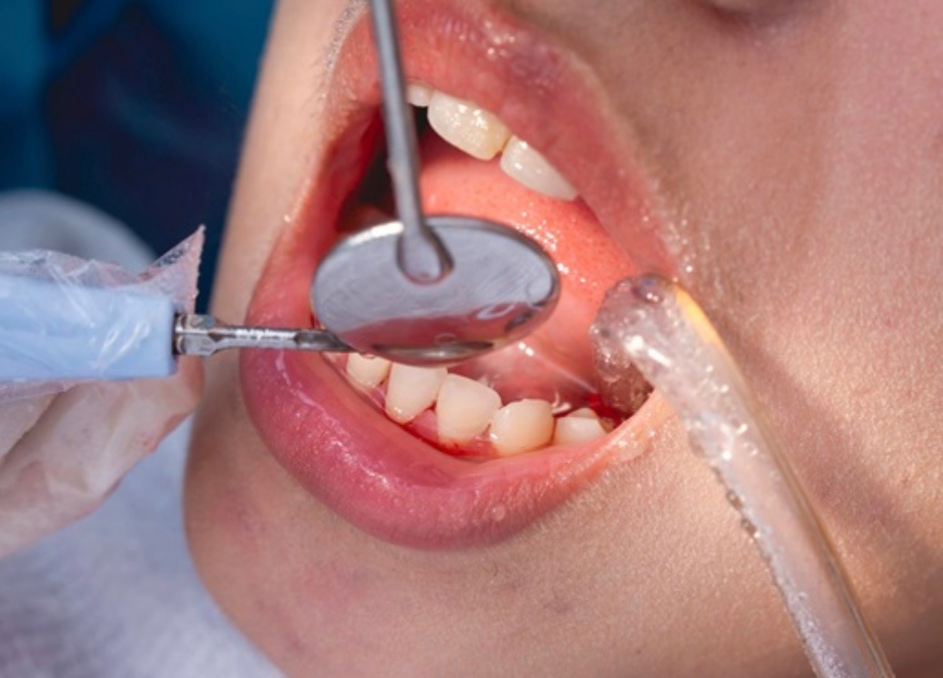 Teeth Cleaning