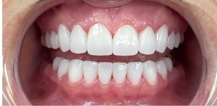 Smile makeover quoted by DR.kenny smiles 