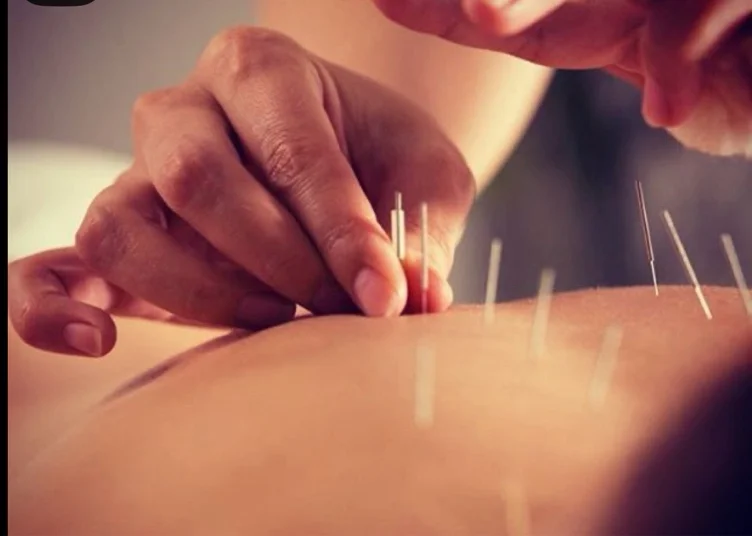 Acupuncture 
