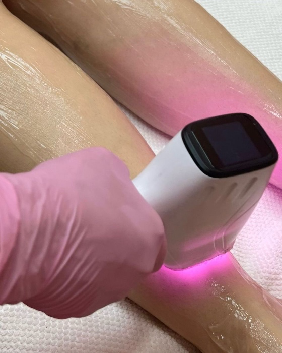 laser removal