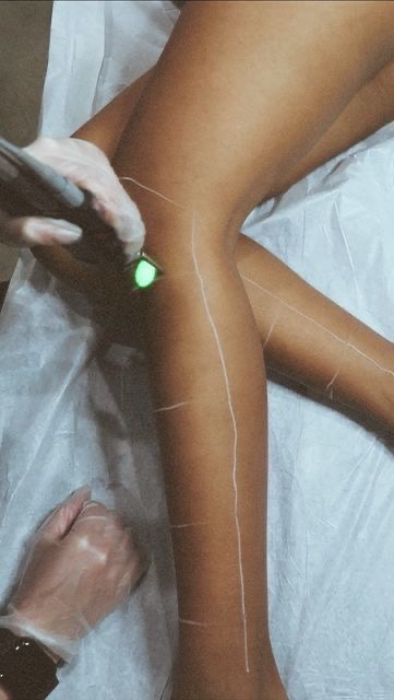 laser removal