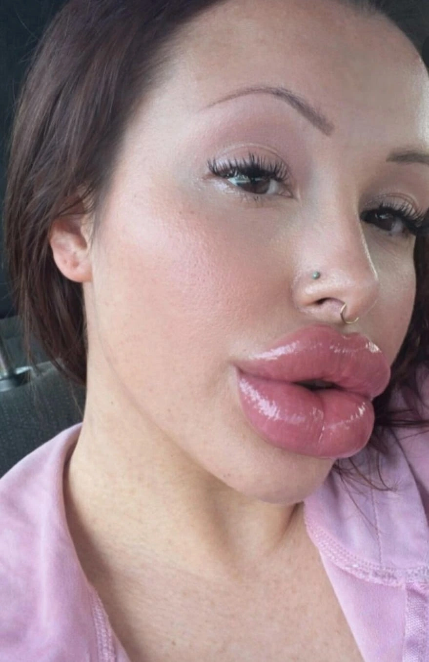 Lip Fillers