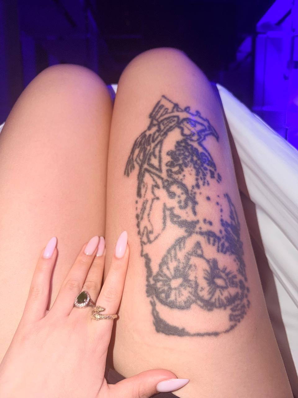 Removal of my tattoo