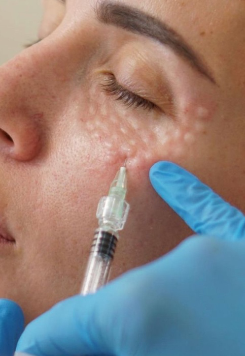 1 Year of Injectables (once every 5 months)
