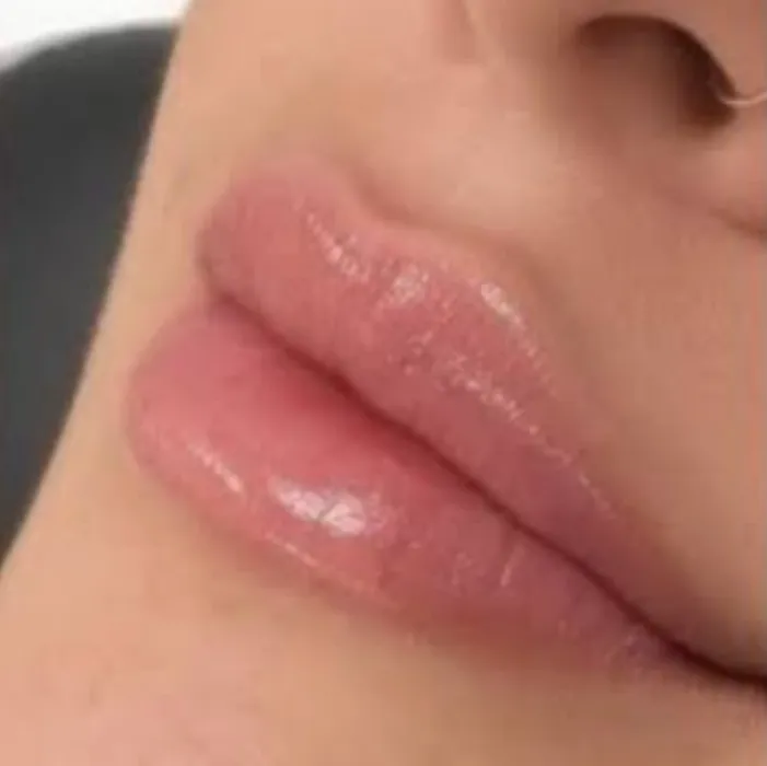 Lip filler 