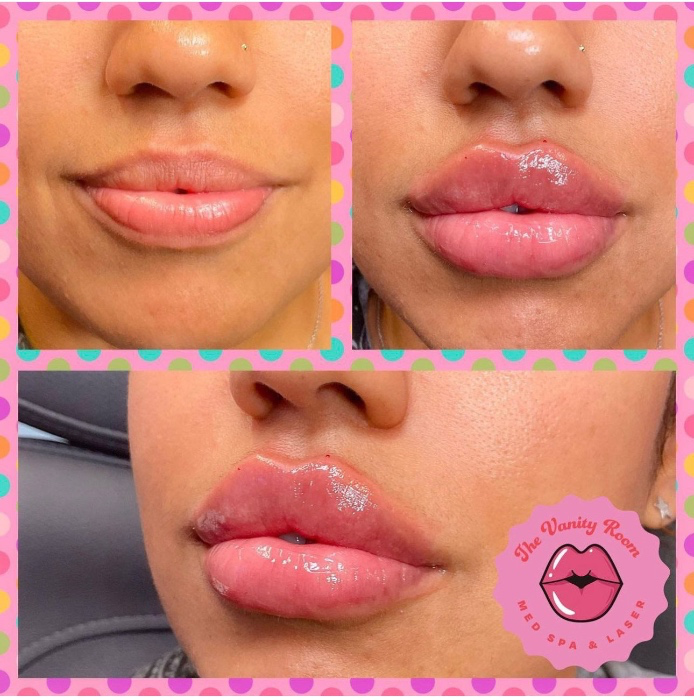 Pay for my lip injections 