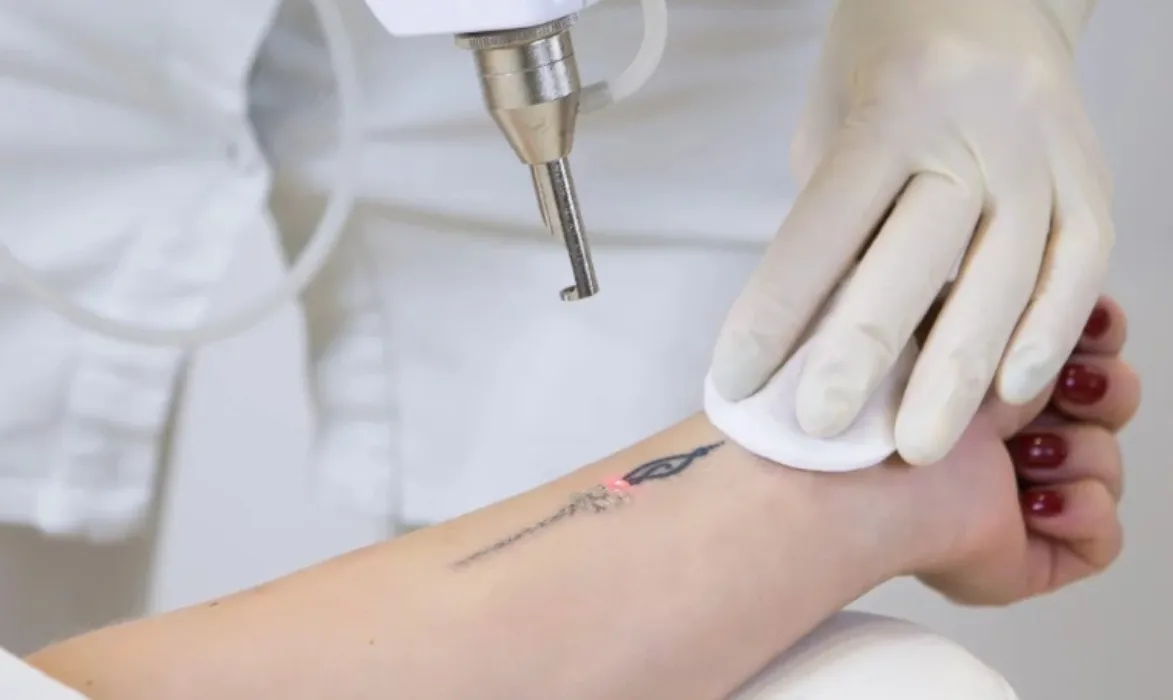 Tattoo Removal