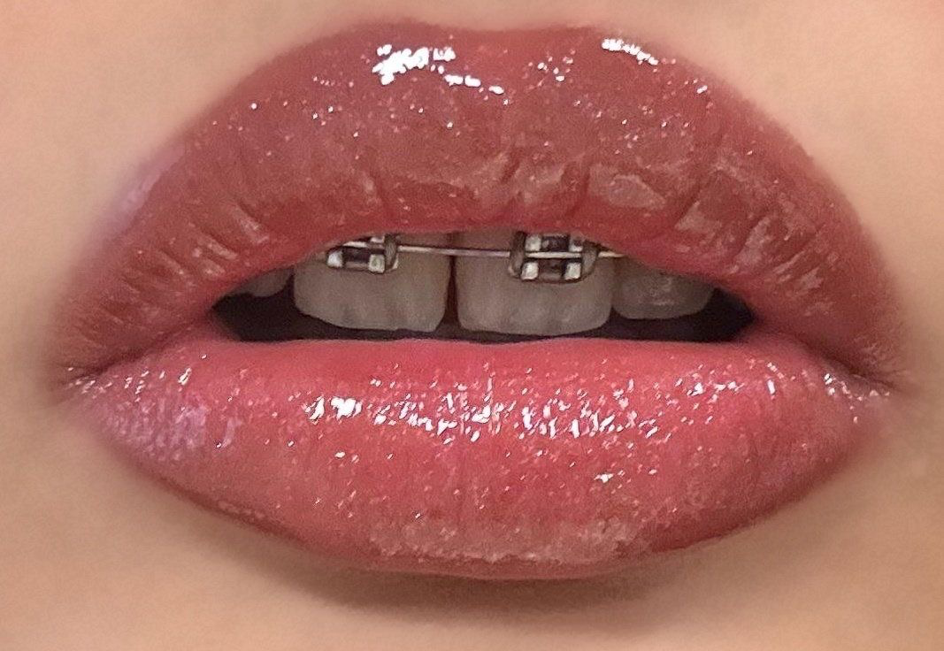 braces 💋
