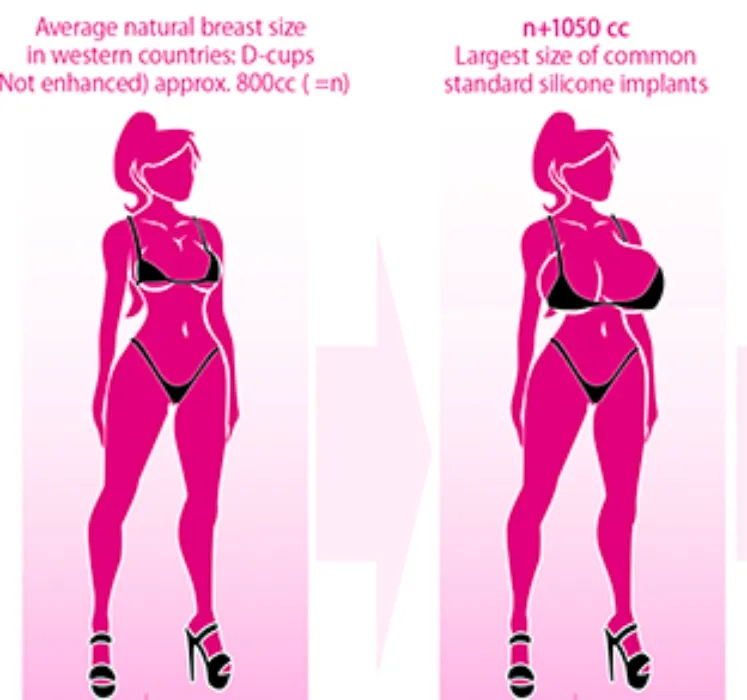 DD replacement implants