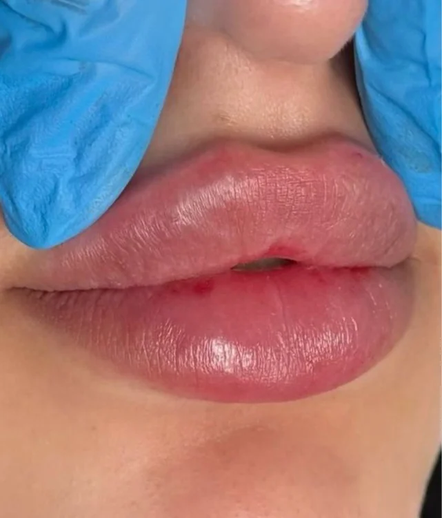 Lip filler