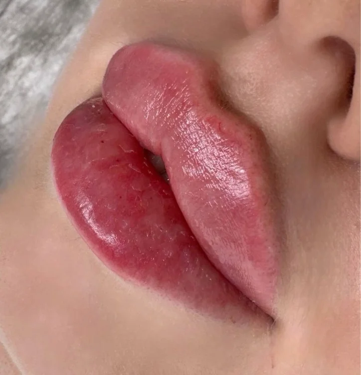 💉(444)