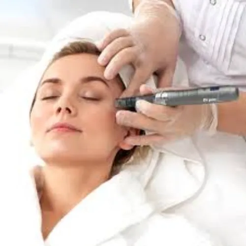 Microneedling treatment