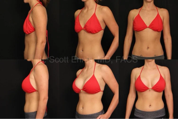 Fund my breast augmentation , (1/2)