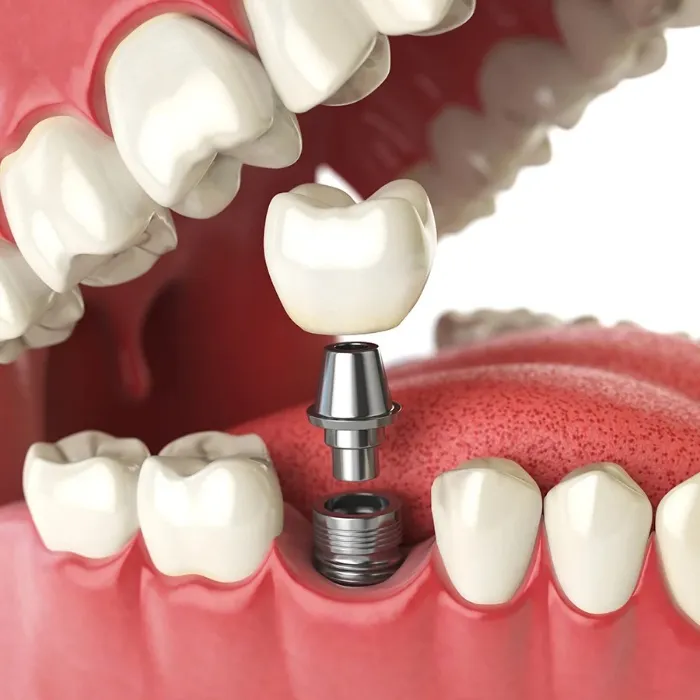 Individual Full-Mouth Dental Implants 🦷 - Part 6 of 12