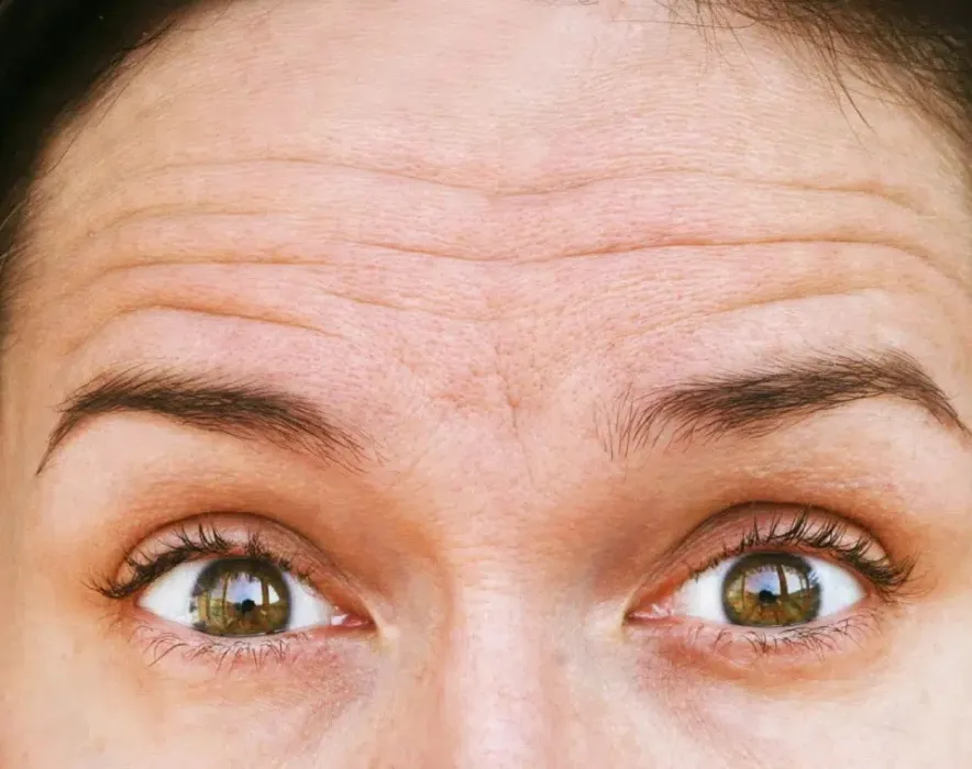 Anti-Wrinkle Forehead Botox