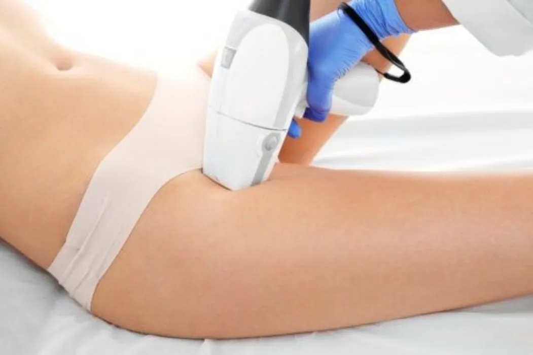 Depilacion Laser sesion 