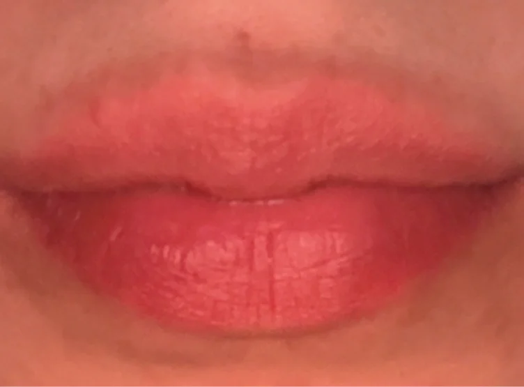 Lip filler 